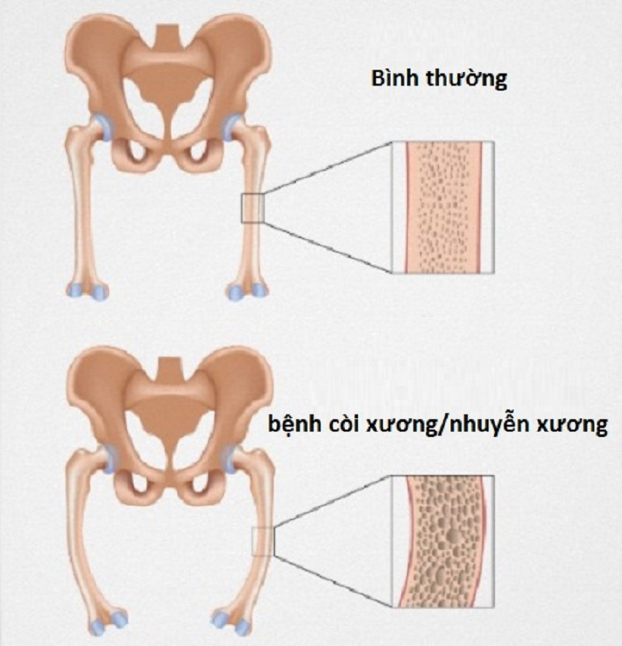 vai-tro-cua-canxi-vơi-xuong-khop